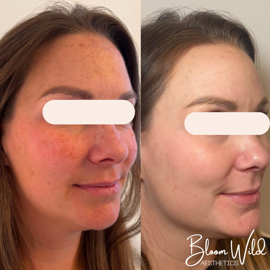 laser skin rejuvenation Murfreesboro