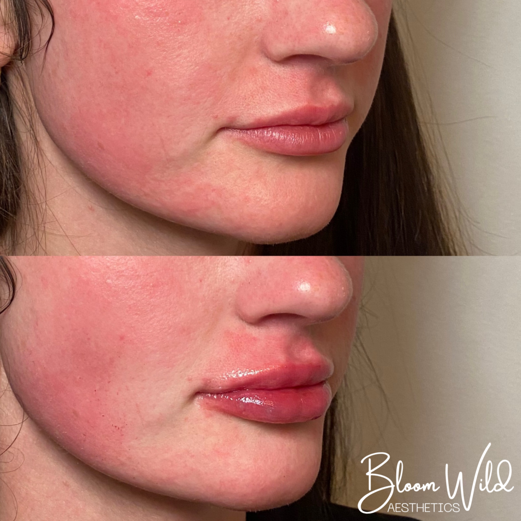 natural lip filler results Murfreesboro