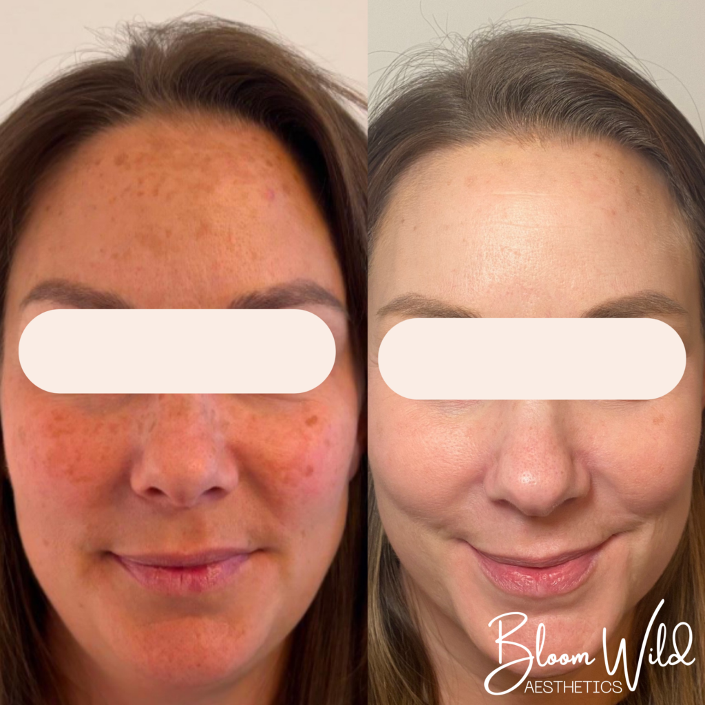 laser skin care Murfreesboro