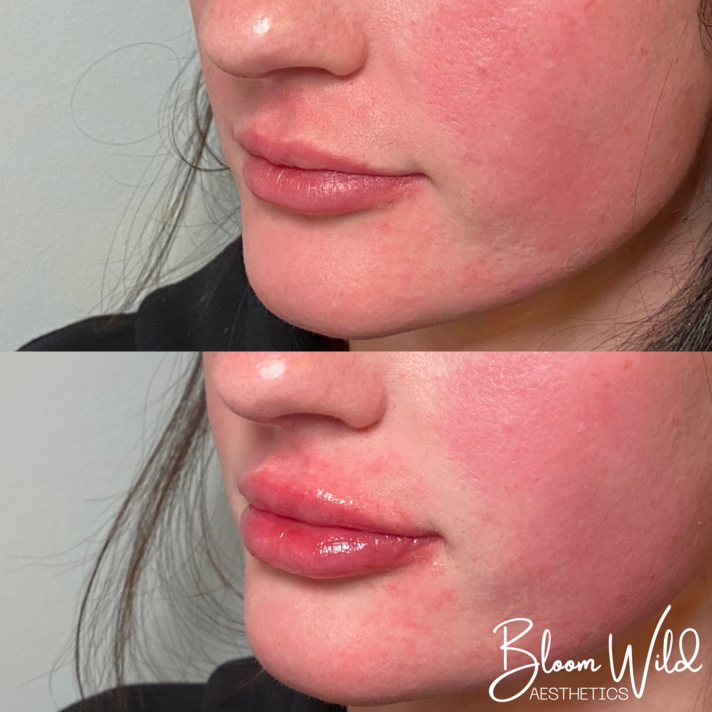 lip filler results Murfreesboro