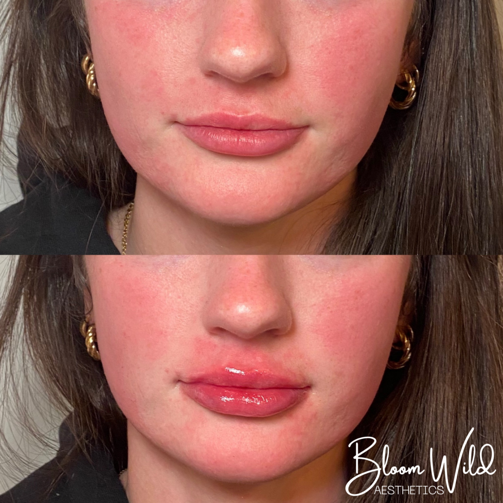 natural lip filler filler Murfreesboro