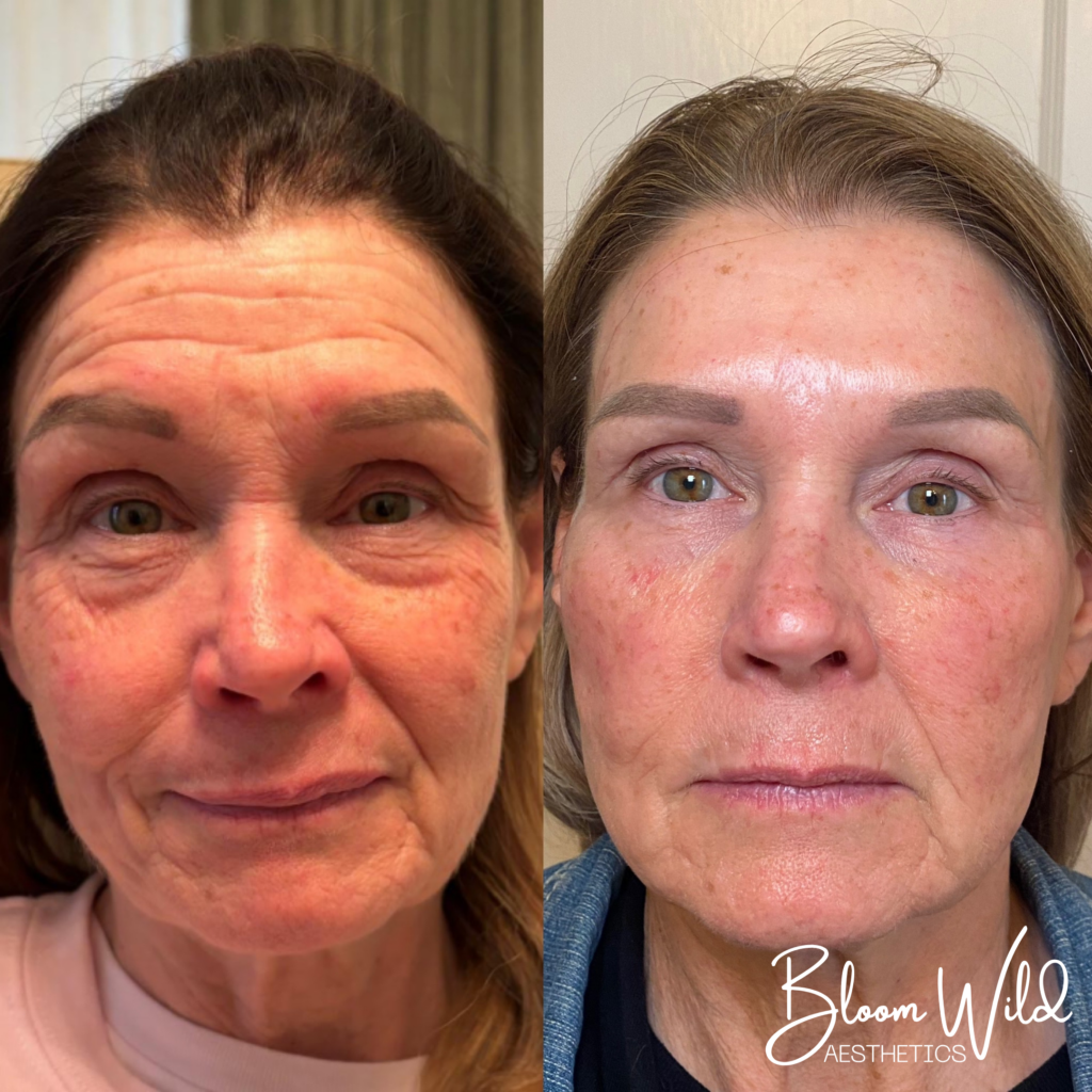 under eye filler before and after