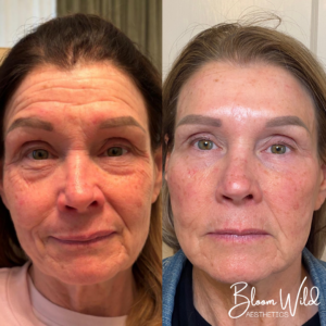under eye filler before and after