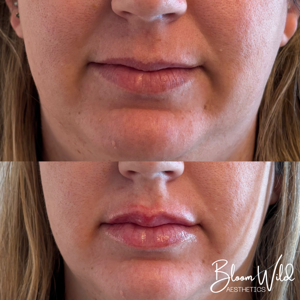 Murfreesboro patient lip filler before and after