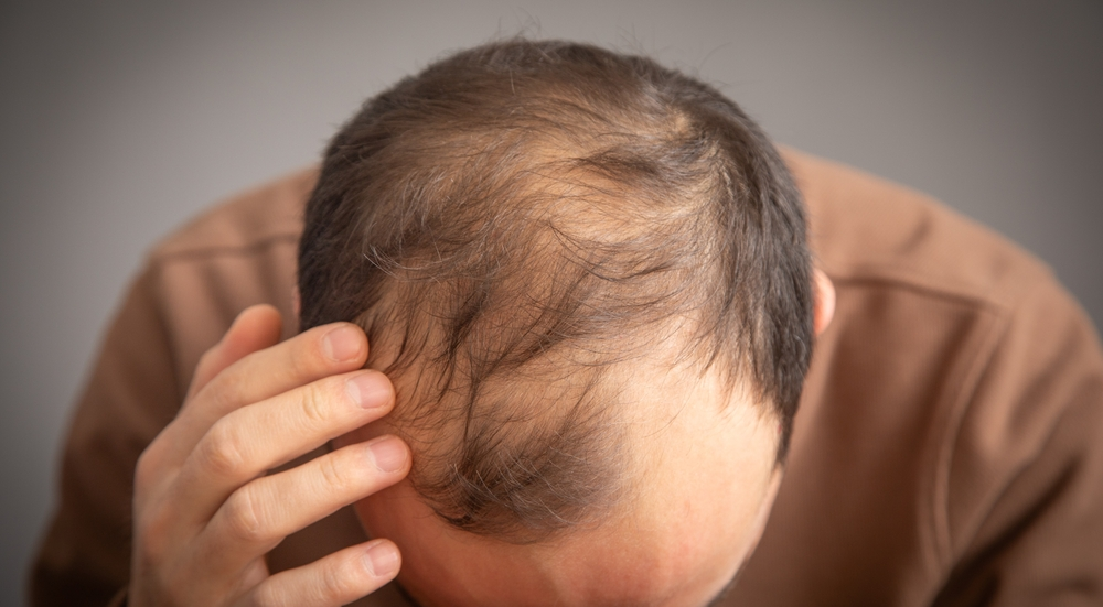 Hair Loss Specialist Near Murfreesboro, Tennessee