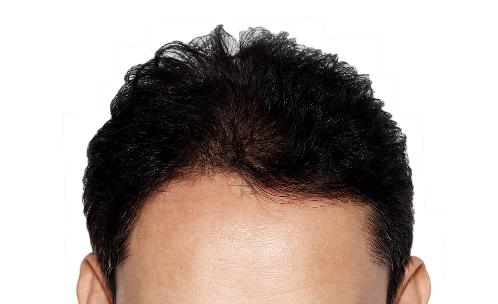 Best Hair Restoration Medspa in Murfreesboro